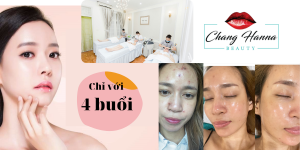 Chăm sóc da mụn tại Chang Hanna Beauty