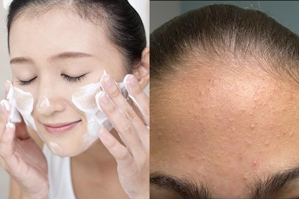 Chăm sóc da và trị mụn ẩn dưới da như thế nào cho hiệu quả?