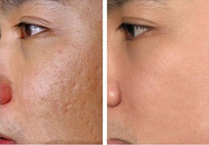 Điều trị sẹo