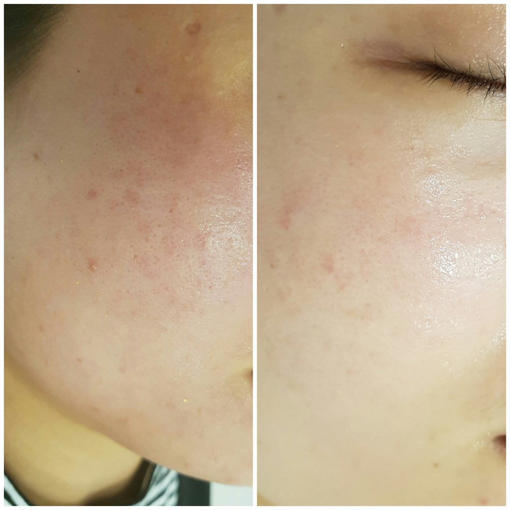 Hình ảnh của khách sàng sau 4 buổi dùng Vi tảo đông y