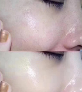 Hình ảnh khách hàng sau sử dụng vi tảo căng bóng collagen