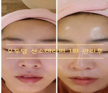 Hình ảnh khách hàng sau sử dụng vi tảo căng bóng collagen
