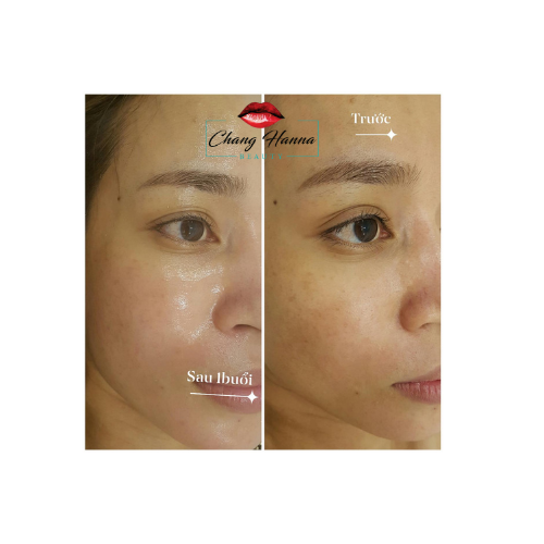 Hiệu quả sau khi sử dụng 1 buổi Oxy therapy tại Chang Hanna Beauty