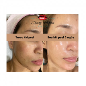 Hình ảnh khách hàng sau khi sử dụng công nghệ B Tox Peel
