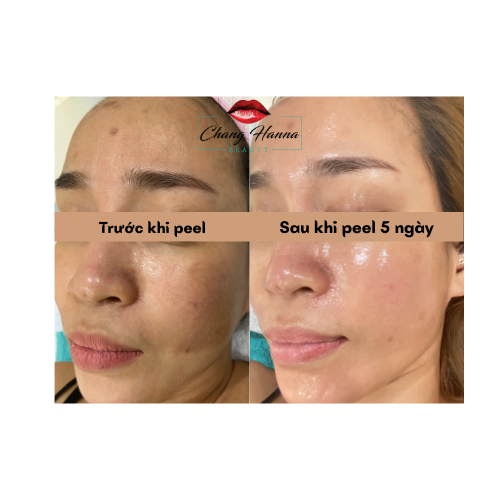 Hình ảnh khách hàng sau khi sử dụng công nghệ B Tox Peel - Tái tạo da