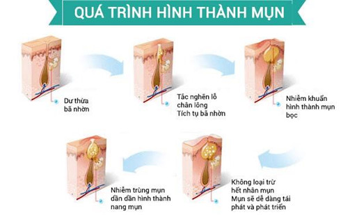 nguyên nhân da bị mụn