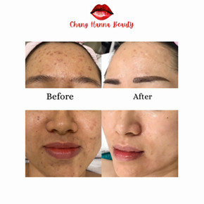 trước và sau khi được chăm sóc tại spa chan hanna