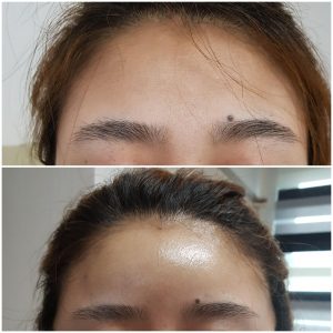 Làm đầy trán bằng Filler