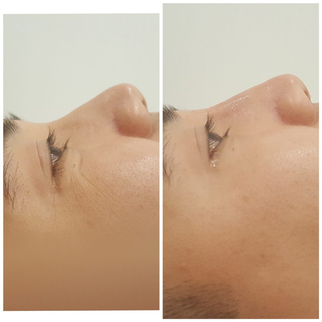 Filler mũi