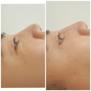 Filler mũi