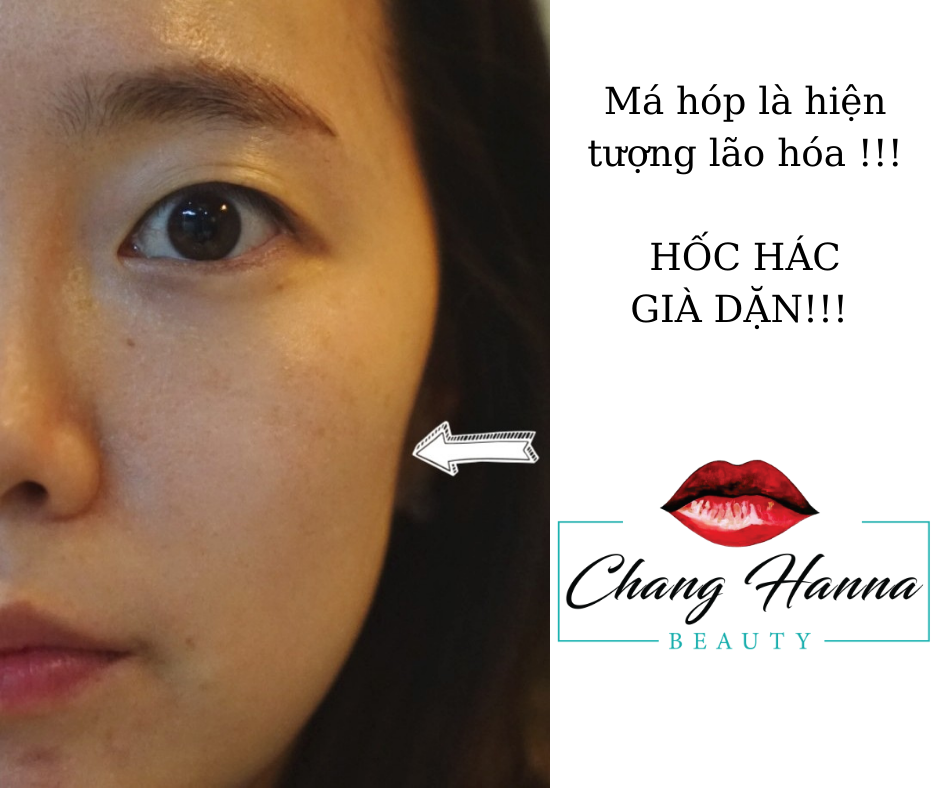 Cải Thiện Làm đầy Má Hóp Hàn Quốc.