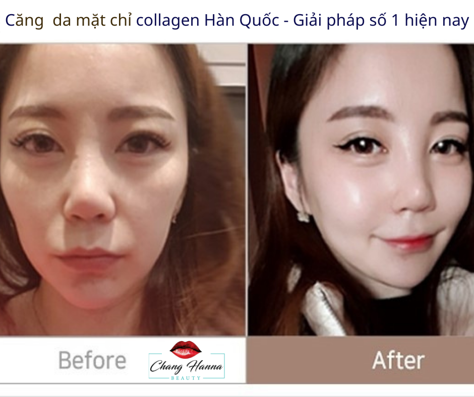 Căng Da Mặt Chỉ Collagen Hàn Quốc Giair Pháp Số 1 Hiện Nay