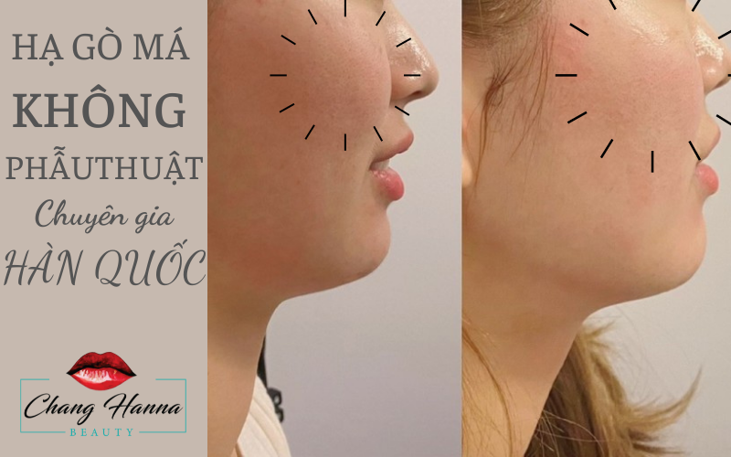 Hạ gò má không phẫu thuật
