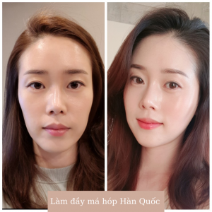 Làm đầy Má Hớp Hàn Quốc