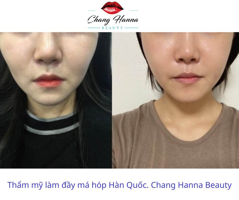 Làm đầy Má Hóp Hàn Quốc. Chang Hanna Beautypng