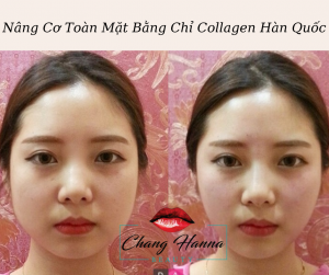 Căng da Mặt Bằng Chỉ Collagen Hàn Quốc