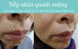 Xóa Nếp Nhăn Quanh Miệng bằng chỉ collagen