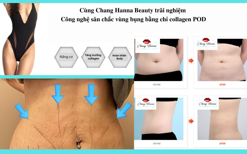 Săn Chắc Vùng Bụng Bằng Chỉ Collagen