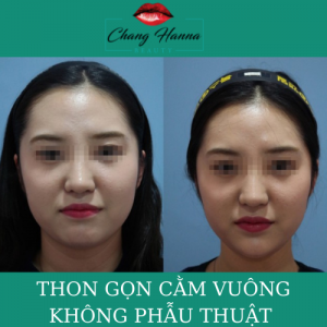 Thon GỌn CẰm VuÔng KhÔng PhẪu ThuẬt
