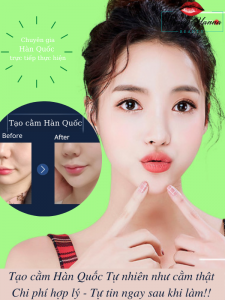 cằm lẹm cằm ngắn