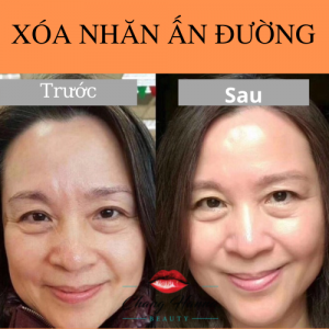 Trước