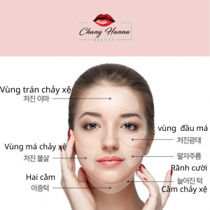 Căng chỉ toàn mặt chống lão hóa