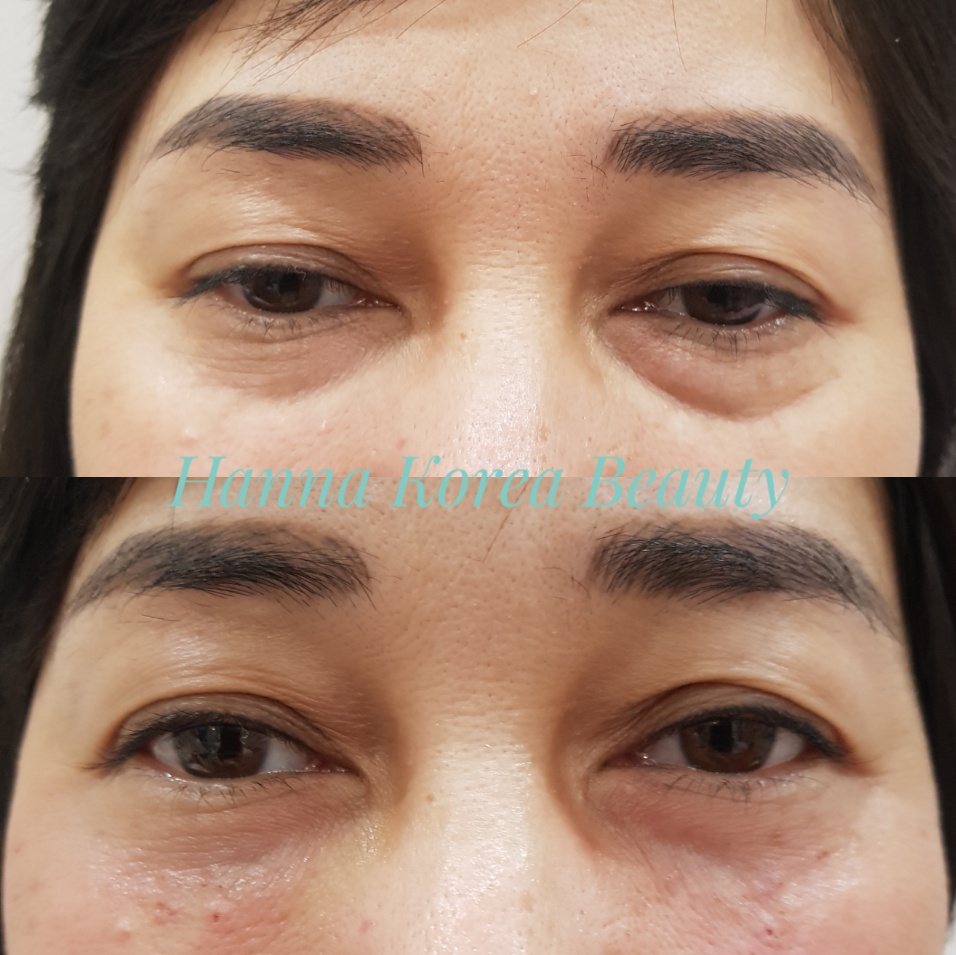 Xóa nhăn bọng mắt bằng chỉ collagen
