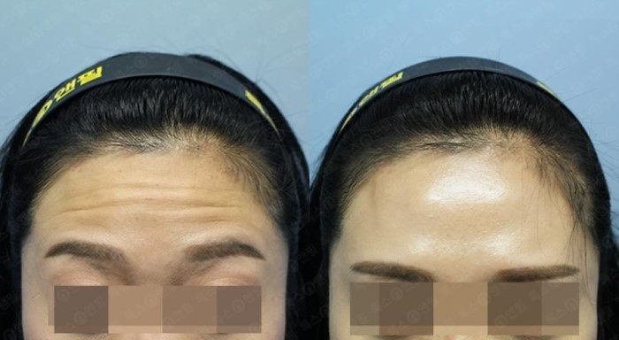 Xóa nhăn trán bằng botox
