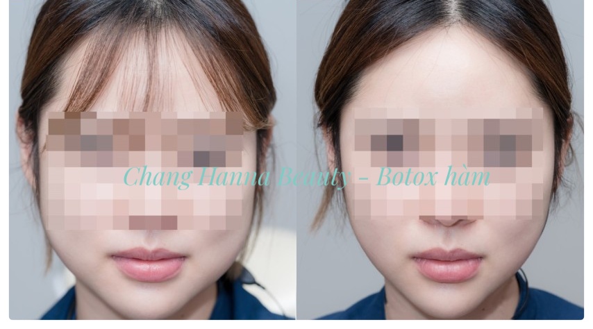 Tiêm botox thu gọn hàm