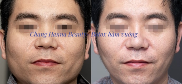 Tiêm botox thu gọn hàm