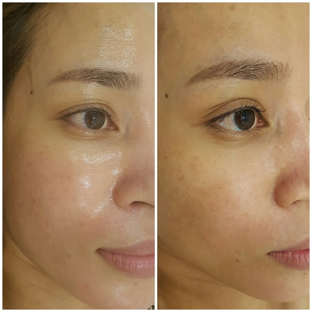 điều trị nám bằng nhau thai