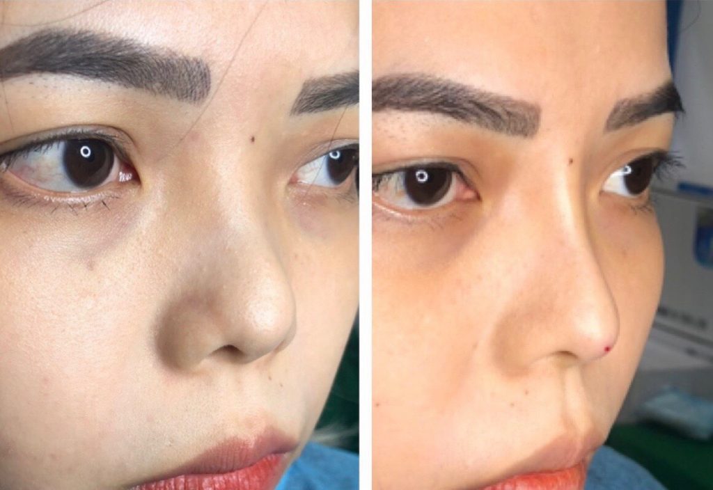 Hình ảnh trước sau nâng mũi không phẫu thuật