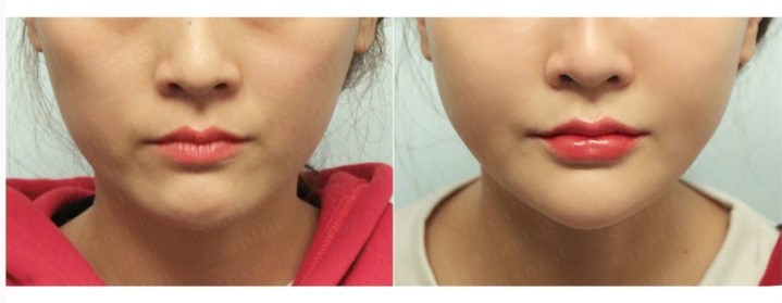 Tiêm độn cằm vline. Chang Hanna Beauty