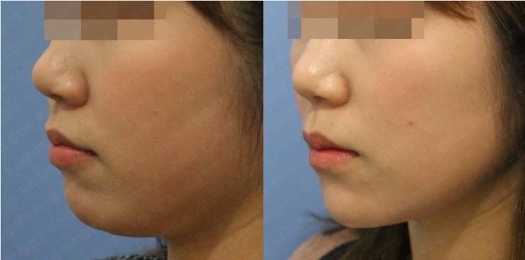 Tiêm độn cằm bằng filer kết quả ngay sau khi làm. Chang Hanna Beauty
