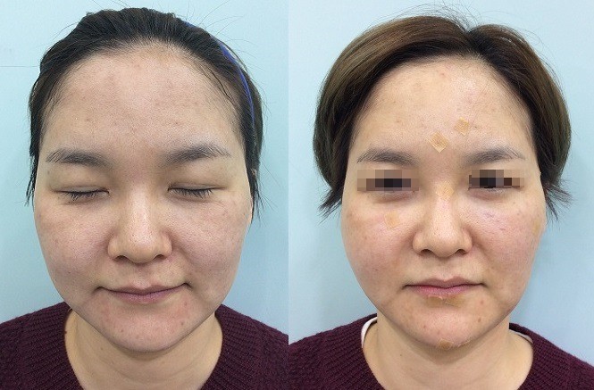 Hình ảnh trước sau khi trẻ hóa da măt bằng chỉ collagen