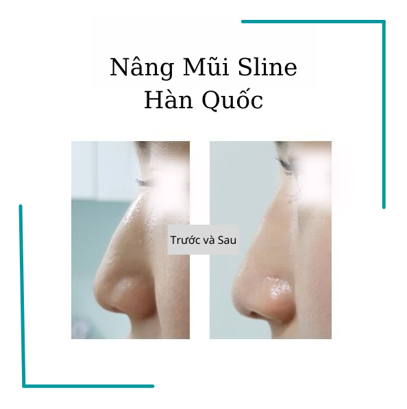 Nâng mũi filler