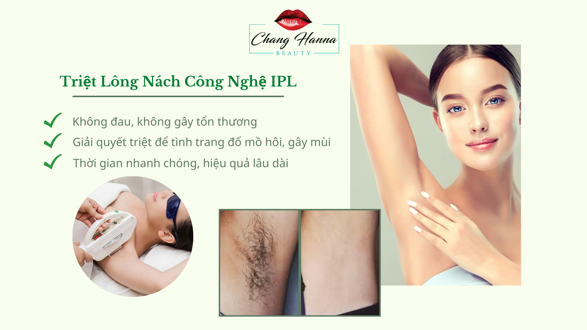Triệt lông nách công nghệ IPL
