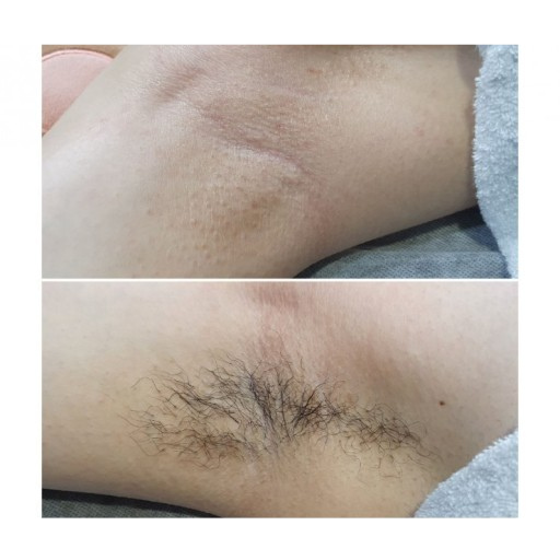 Triệt lông vĩnh viễn IPL