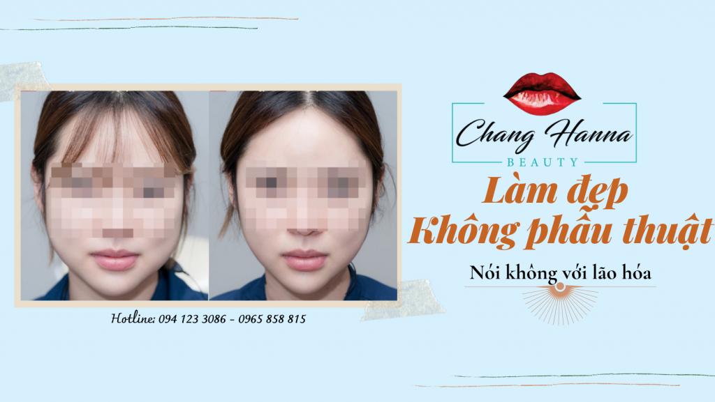 Căng da mặt chỉ collagen