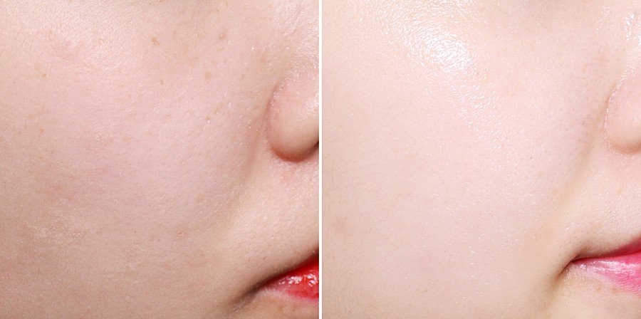 Spa điều trị nám. Chang Hanna Beauty
