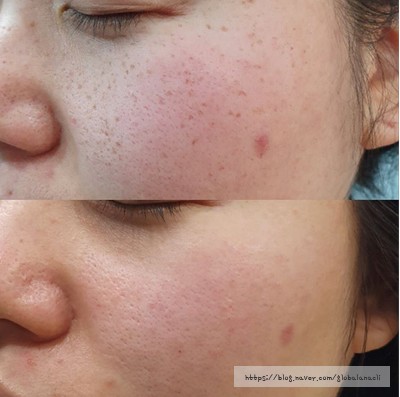 Tế bào gốc trị tàn nhang