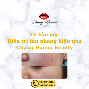 tế bào gốc trị tàn nhang