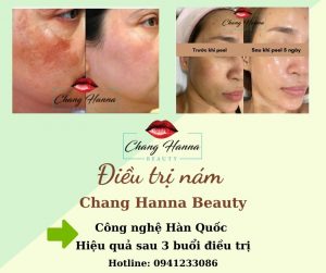 Điều Trị Da Nám