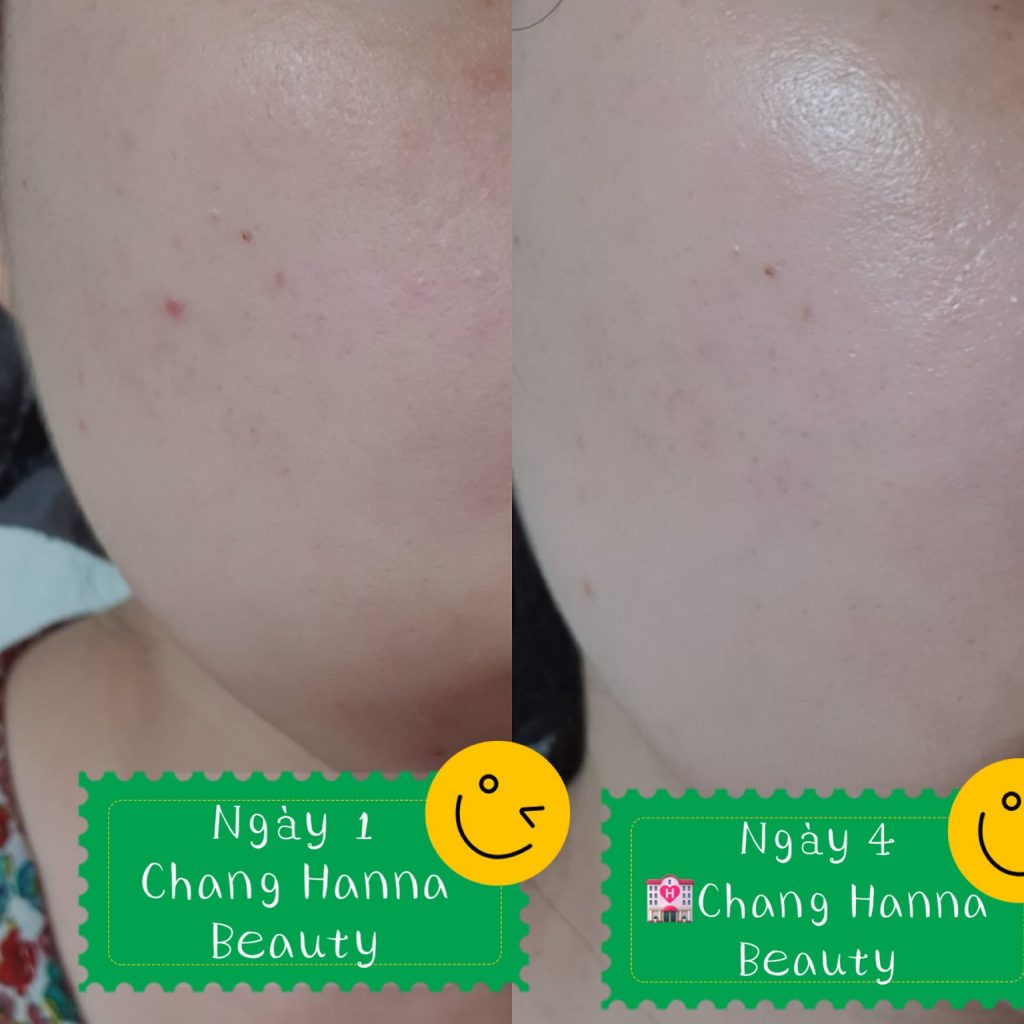 kết quả sau khi sử dụng tế bào gốc điều trị nám tàn nhang