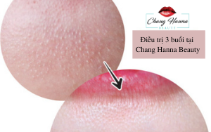Mụn trứng cá
