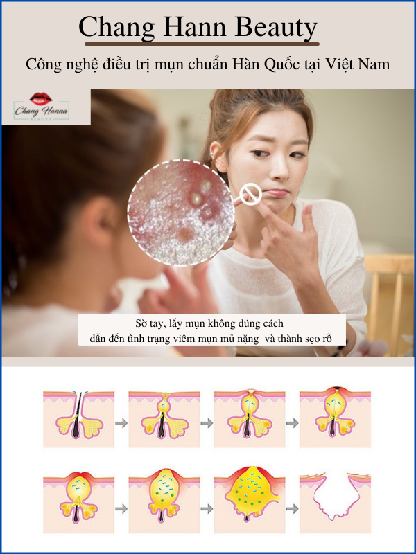 Mụn và liệu trình điều trị tại Chang Hanna Beauty