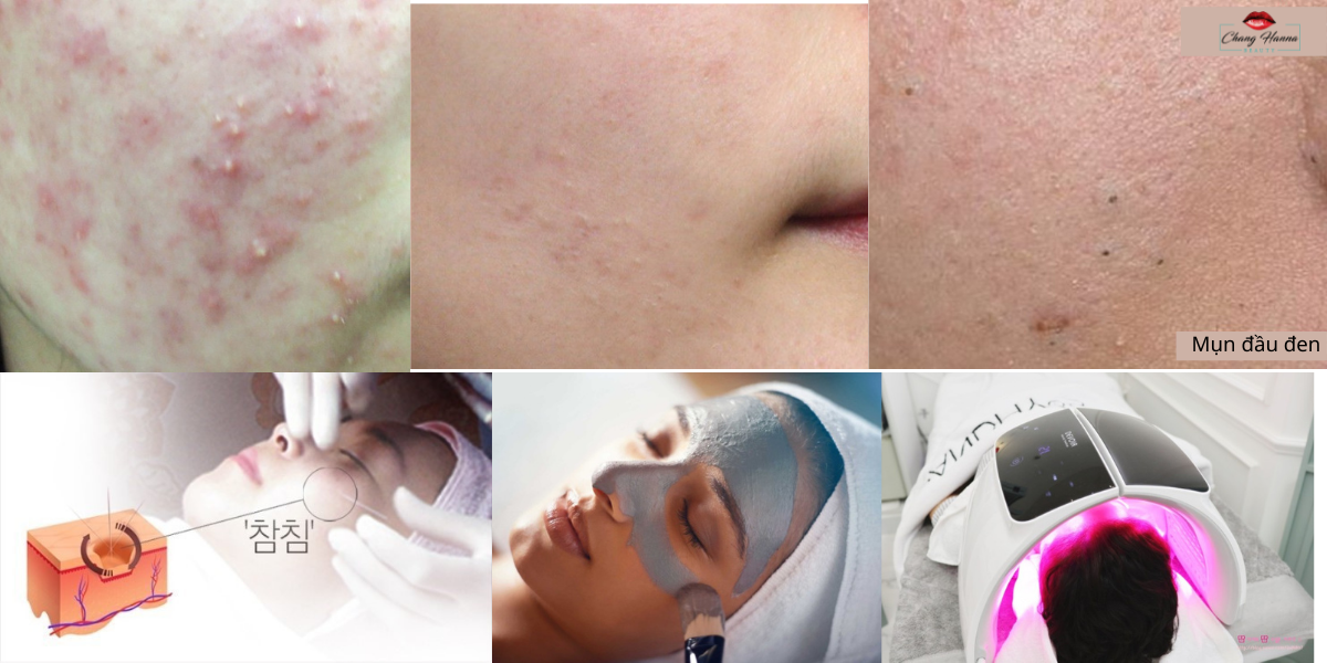 điêu Trị Mụn Tai Chang Hanna Beauty
