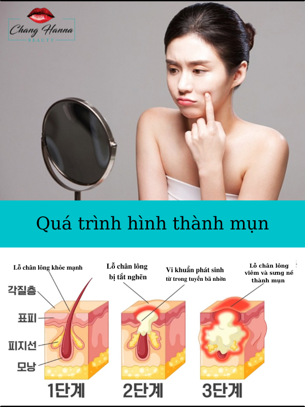 Quá Trình Hình Thành Mụn