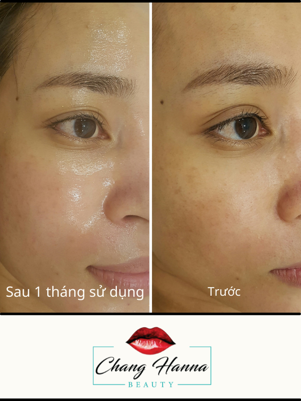 Trước Và Sau 1 Tháng Sử Dụng