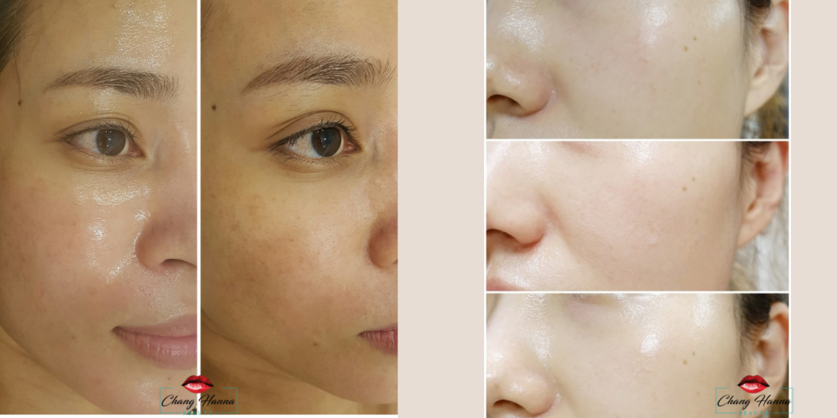 Tế bào gốc trị nám SRS Matrigen Hàn Quốc